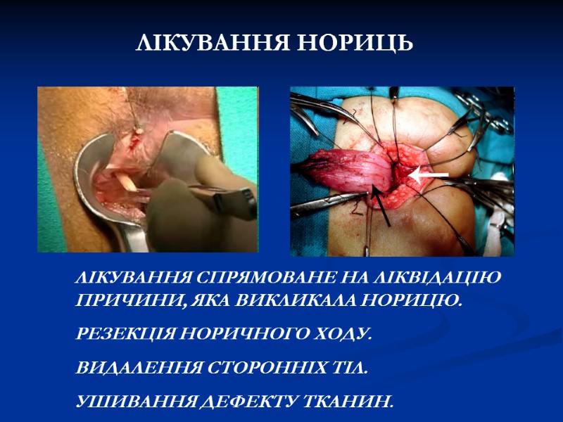 ЛІКУВАННЯ НОРИЦЬ ЛІКУВАННЯ СПРЯМОВАНЕ НА ЛІКВІДАЦІЮ ПРИЧИНИ, ЯКА ВИКЛИКАЛА НОРИЦЮ. РЕЗЕКЦІЯ НОРИЧНОГО ХОДУ. ЛІКУВАННЯ НОРИЦЬ ЛІКУВАННЯ СПРЯМОВАНЕ НА ЛІКВІДАЦІЮ ПРИЧИНИ, ЯКА ВИКЛИКАЛА НОРИЦЮ. РЕЗЕКЦІЯ НОРИЧНОГО ХОДУ.